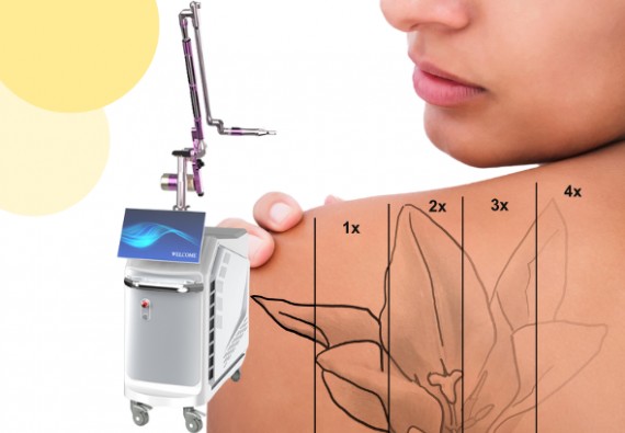 NOVINKA! ODSTRANĚNÍ TETOVÁNÍ ŠPIČKOVÝM PIKOSEKUNDOVÝM LASEREM!