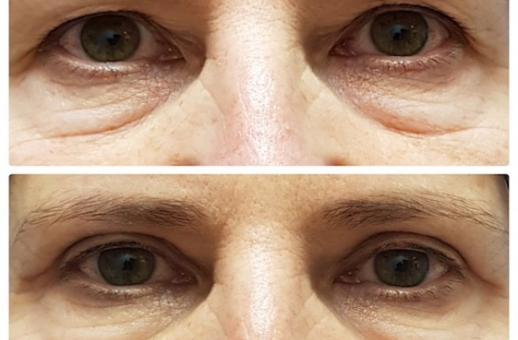 Plastika horních víček