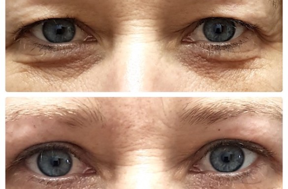 Plastika horních víček