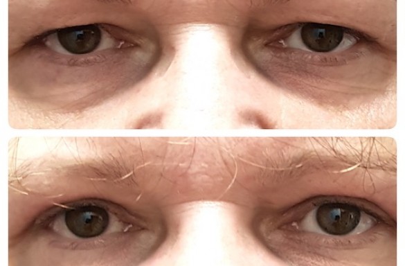 Plastika horních víček