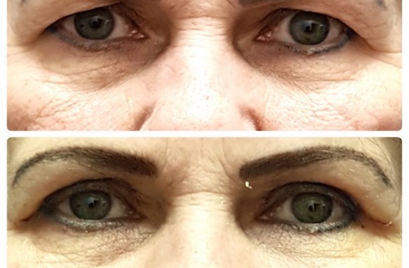 Plastika horních víček