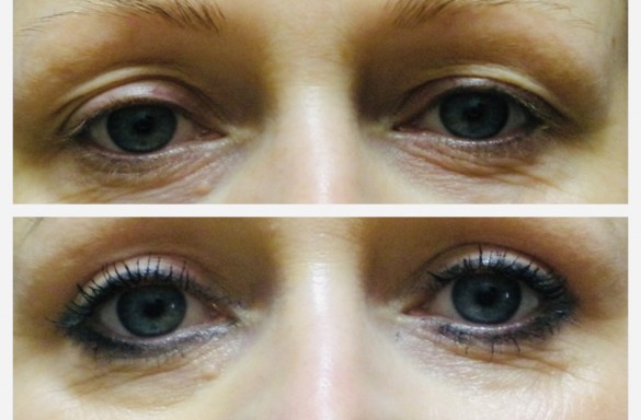 Plastika horních víček