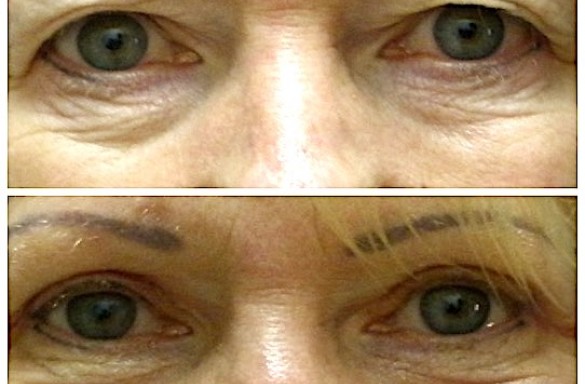 Plastika horních víček