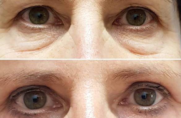 Plastika horních víček