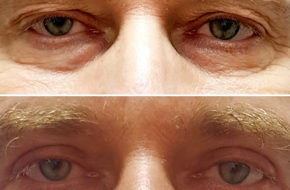 Plastika horních víček