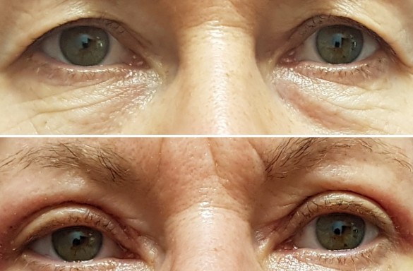 Plastika horních víček