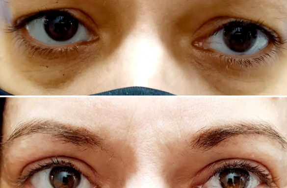 Plastika horních víček