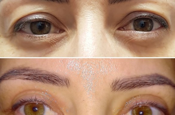 Plastika horních víček