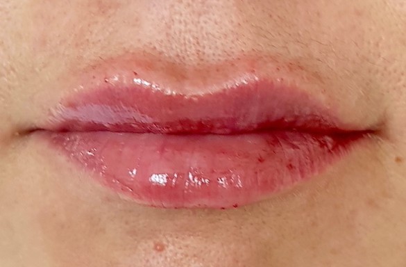 Bezprostředně po aplikaci