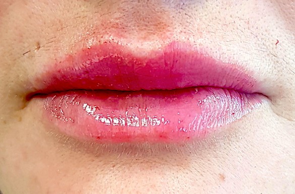 Bezprostředně po aplikaci