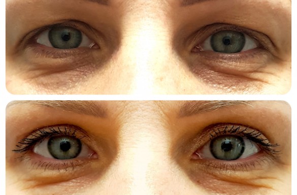 Plastika horních víček