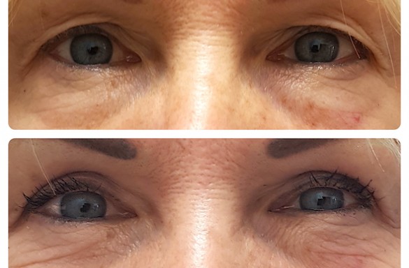 Plastika horních víček