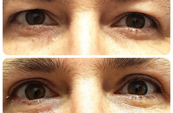 Plastika horních víček