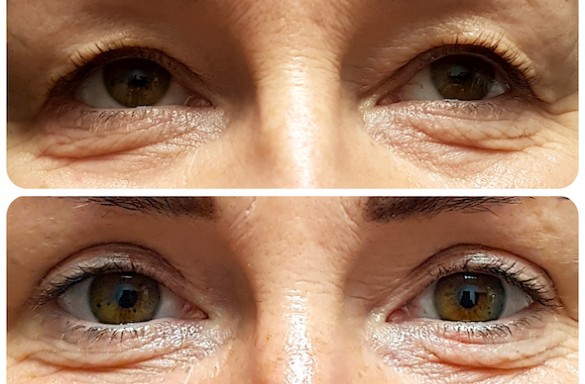 Plastika horních víček