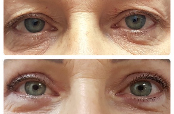 Plastika horních víček