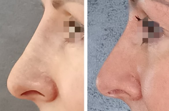 Rhinoplastika zavřenou technikou