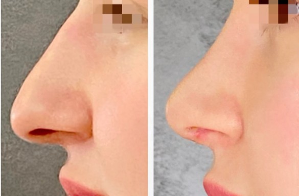 Rhinoplastika otevřenou technikou
