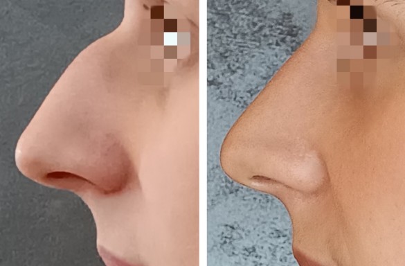 Rhinoplastika zavřenou technikou