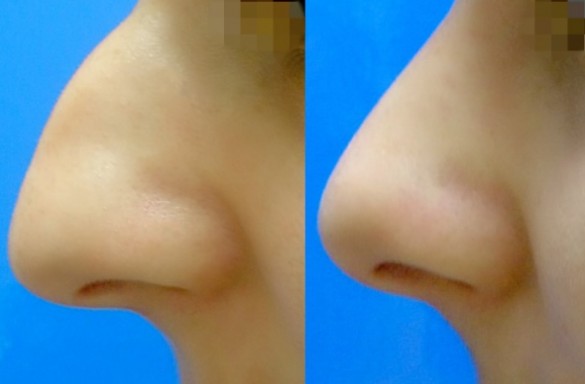 Rhinoplastika zavřenou technikou