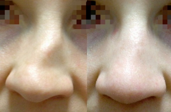 Rhinoplastika otevřenou technikou