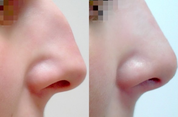 Rhinoplastika zavřenou technikou