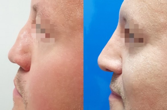 Rhinoplastika otevřenou technikou