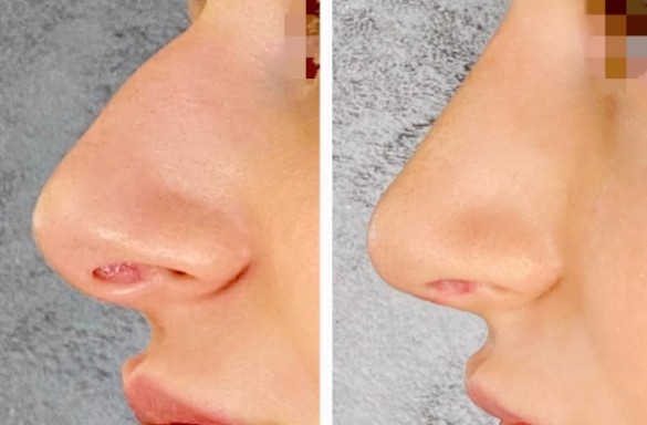 Rhinoplastika otevřenou technikou