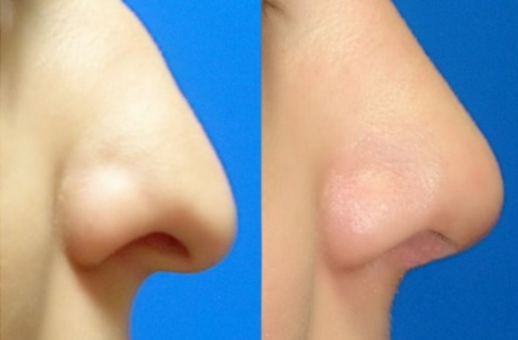 Rhinoplastika otevřenou metodou