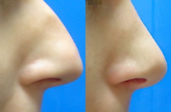 Rhinoplastika zavřenou technikou