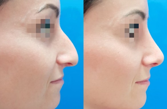 Rhinoplastika otevřenou technikou