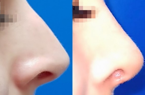 Rhinoplastika zavřenou technikou