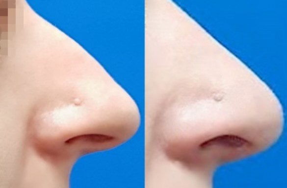 Rhinoplastika otevřenou technikou