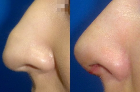 Rhinoplastika otevřenou technikou