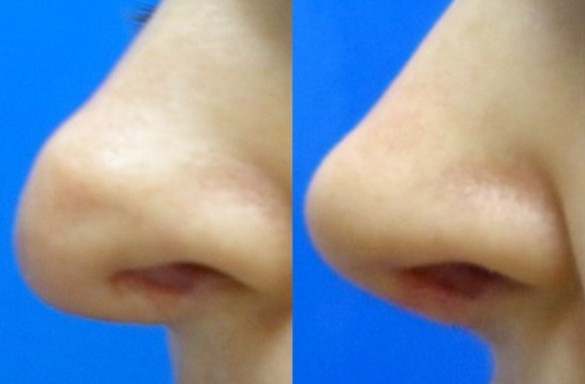 Rhinoplastika otevřenou technikou