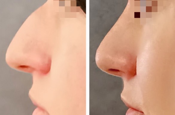 Rhinoplastika zavřenou technikou