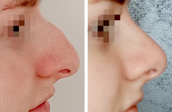 Rhinoplastika zavřenou technikou