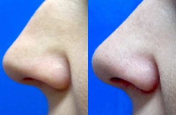 Rhinoplastika zavřenou technikou
