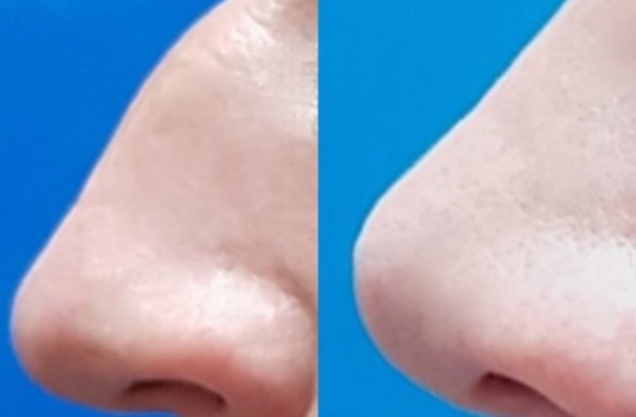 Rhinoplastika zavřenou technikou