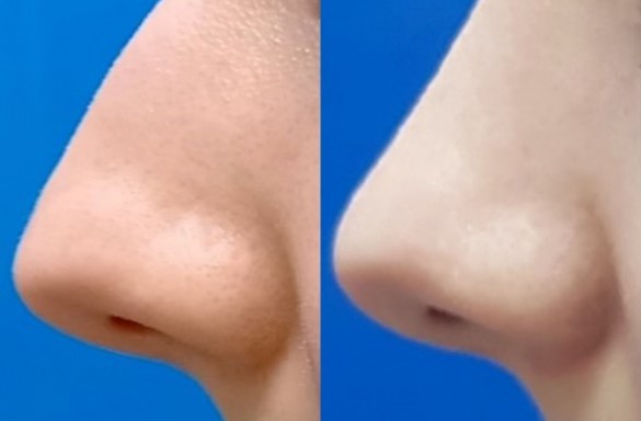 Rhinoplastika zavřenou technikou