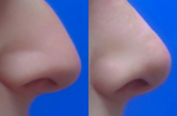Rhinoplastika zavřenou technikou