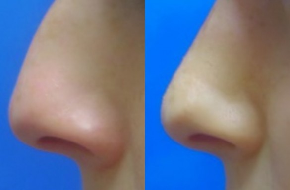 Rhinoplastika zavřenou technikou