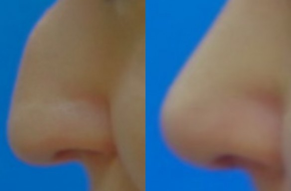 Rhinoplastika zavřenou technikou
