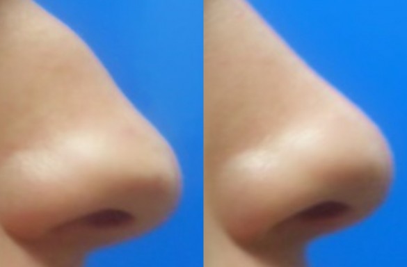 Rhinoplastika zavřenou technikou