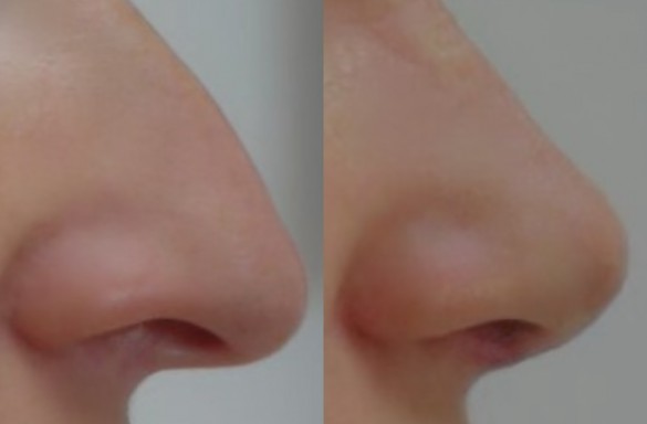 Rhinoplastika otevřenou technikou