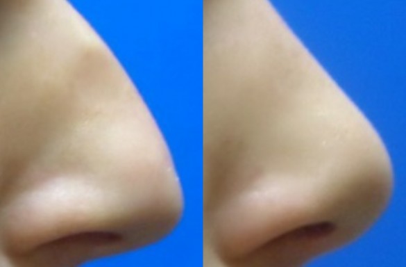 Rhinoplastika zavřenou technikou