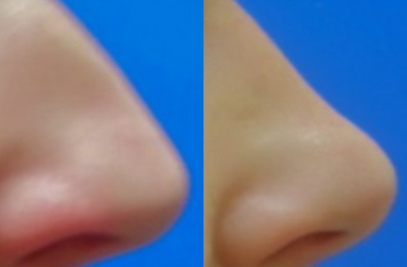Rhinoplastika zavřenou technikou