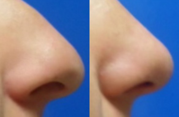 Rhinoplastika zavřenou technikou