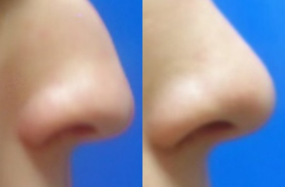 Rhinoplastika zavřenou technikou