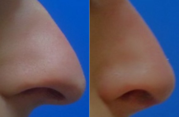 Rhinoplastika otevřenou technikou