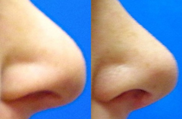 Rhinoplastika otevřenou technikou